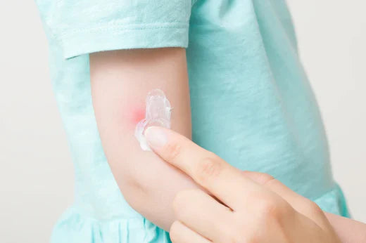 How to Treat Bug Bites: DIY Bug Bite Compound